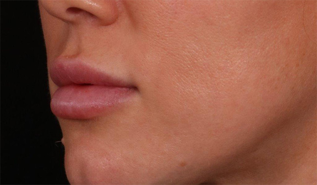 Before Image: Lip Lift - left-front-oblique