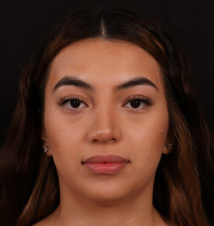 After Image: Rhinoplasty - front
