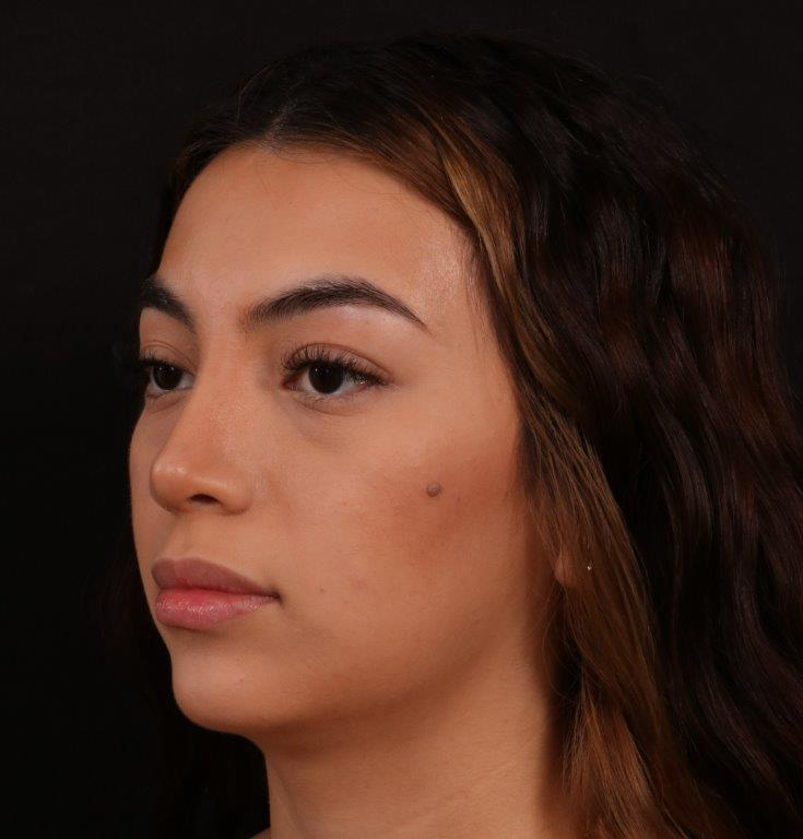 After Image: Rhinoplasty - left-front-oblique