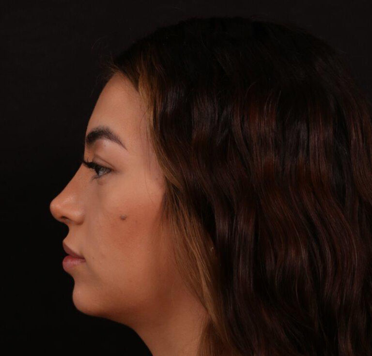 After Image: Rhinoplasty - left-side