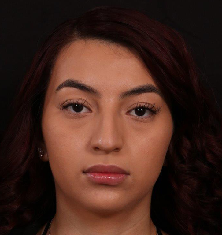Before Image: Rhinoplasty - front