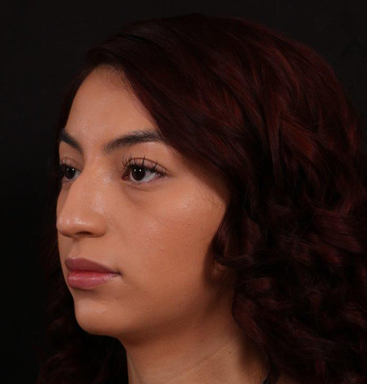 Before Image: Rhinoplasty - left-front-oblique
