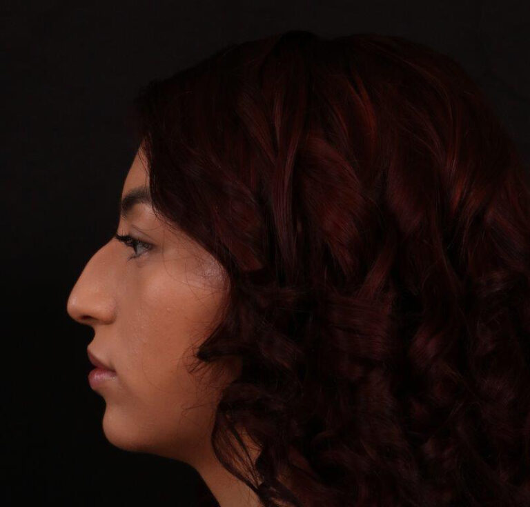 Before Image: Rhinoplasty - left-side