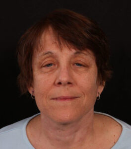 After Image: Neck Lift / Lower Facelift