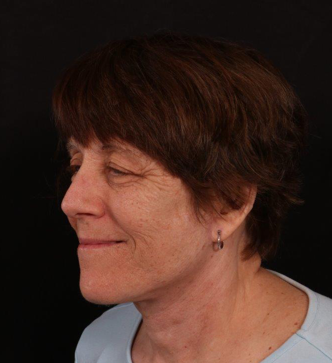 After Image: Neck Lift / Lower Facelift - left-front-oblique