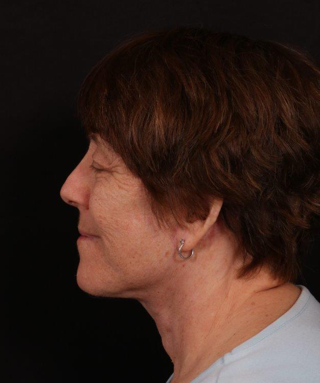 After Image: Neck Lift / Lower Facelift - left-side