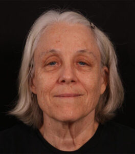 Before Image: Neck Lift / Lower Facelift