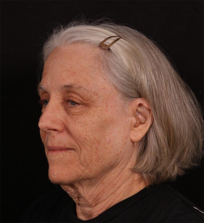 Before Image: Neck Lift / Lower Facelift - left-front-oblique