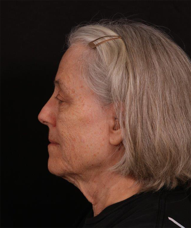 Before Image: Neck Lift / Lower Facelift - left-side