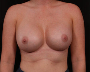 Breast Augmentation