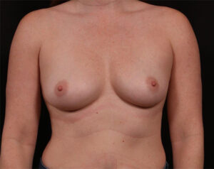 Breast Augmentation
