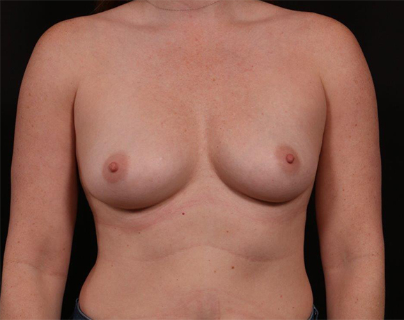 Before Image: Breast Augmentation - front