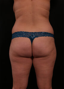 Before Image: Liposuction