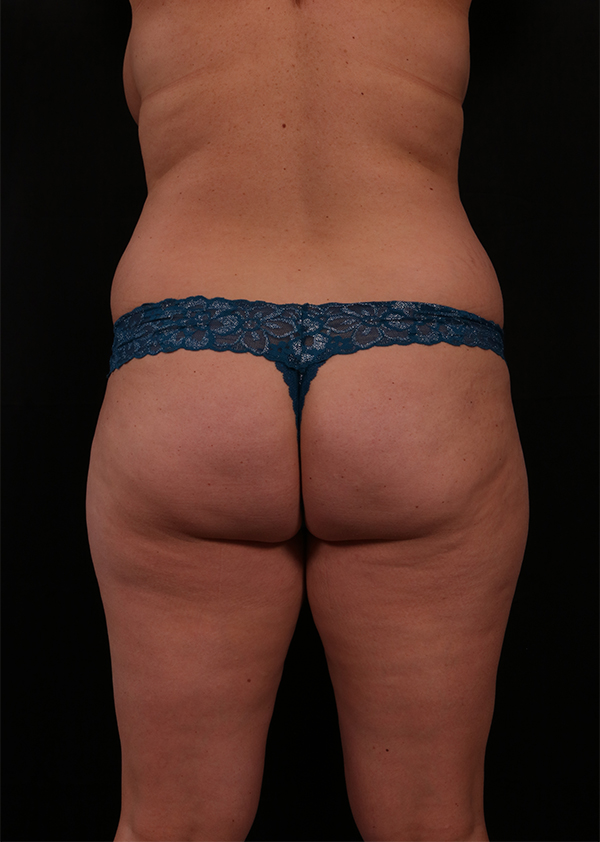 Before Image: Liposuction - back