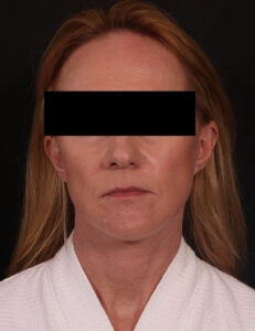 Buccal Fat Removal And Lower Facelift