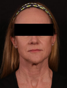 Buccal Fat Removal And Lower Facelift