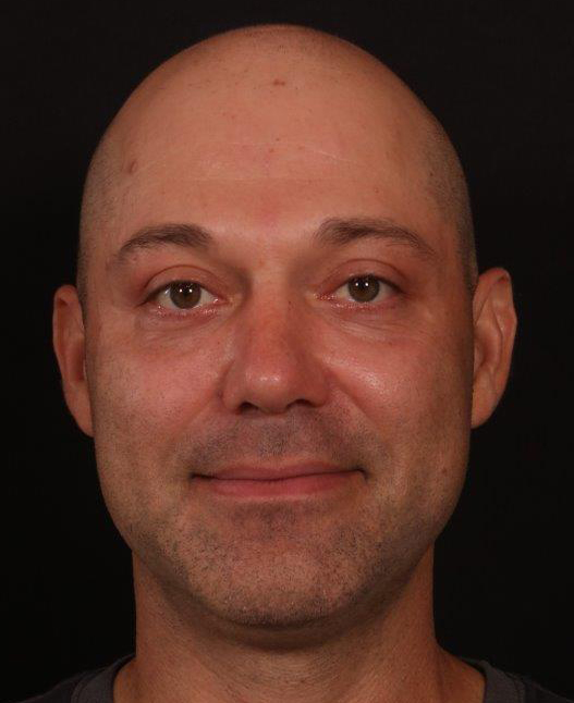 After Image: Rhinoplasty and Upper Blepharoplasty - front