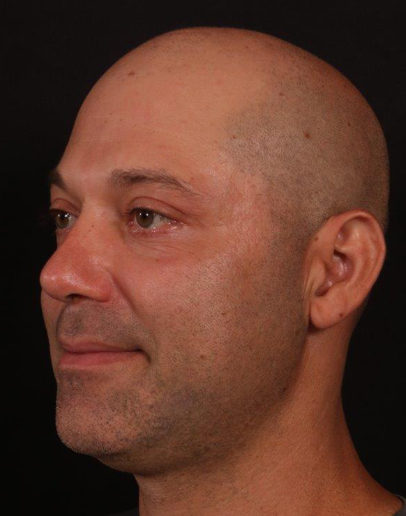 After Image: Rhinoplasty and Upper Blepharoplasty - left-front-oblique