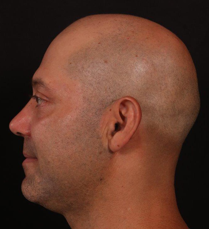 After Image: Rhinoplasty and Upper Blepharoplasty - left-side