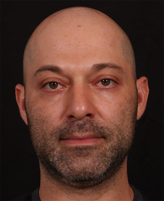 Before Image: Rhinoplasty and Upper Blepharoplasty - front
