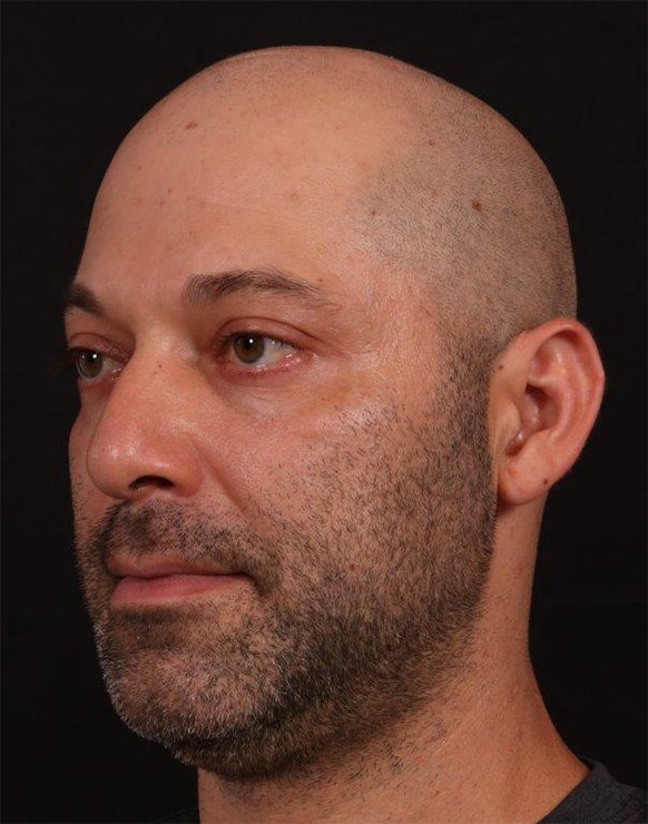 Before Image: Rhinoplasty and Upper Blepharoplasty - left-front-oblique