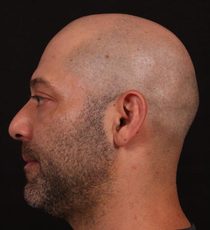Before Image: Rhinoplasty and Upper Blepharoplasty - left-side
