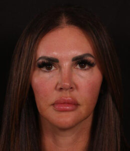 Rhinoplasty