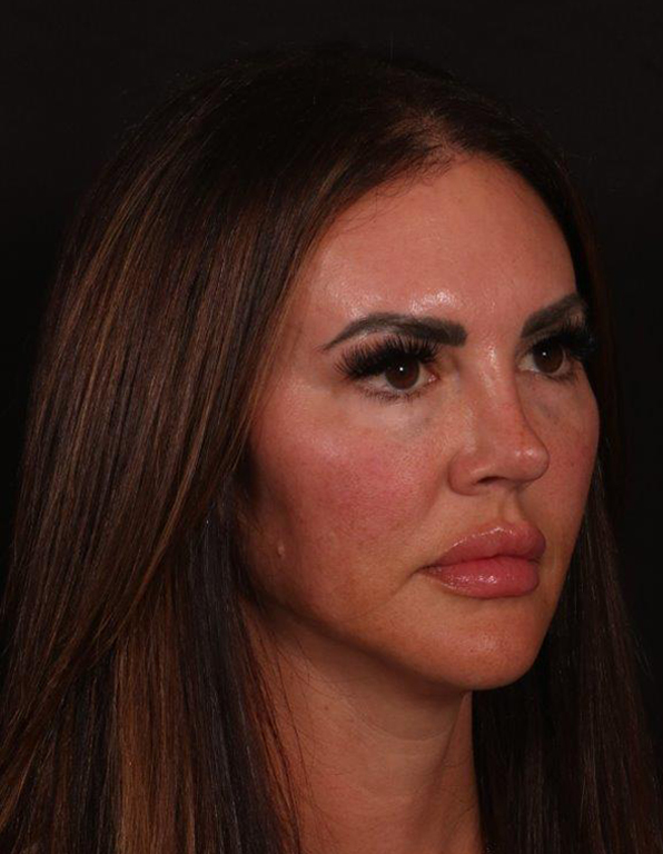 After Image: Rhinoplasty - right-front-oblique
