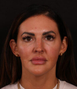 Rhinoplasty