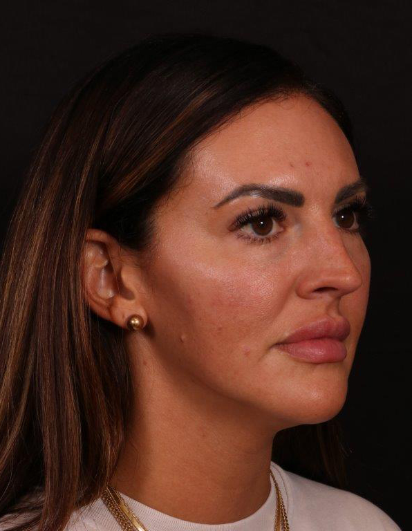 Before Image: Rhinoplasty - right-front-oblique