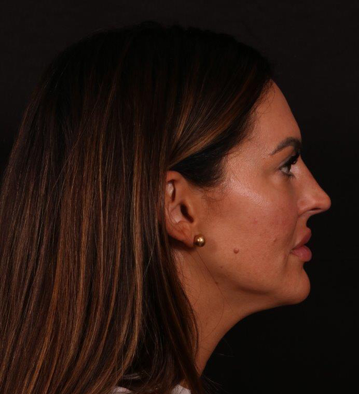 Before Image: Rhinoplasty - right-side