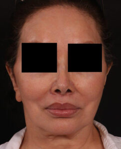 After Image: Lip Lift