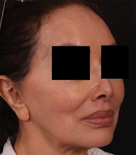 After Image: Lip Lift - right-front-oblique