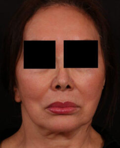 Before Image: Lip Lift