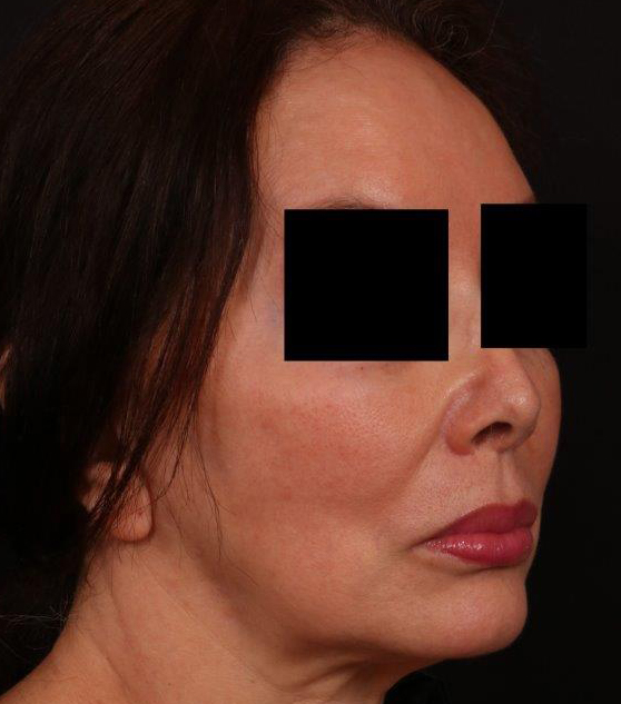 Before Image: Lip Lift - right-front-oblique