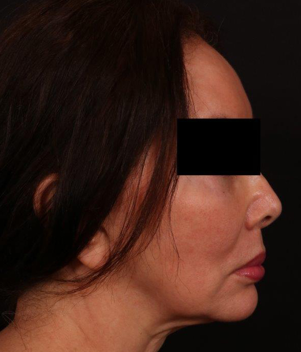 Before Image: Lip Lift - right-side