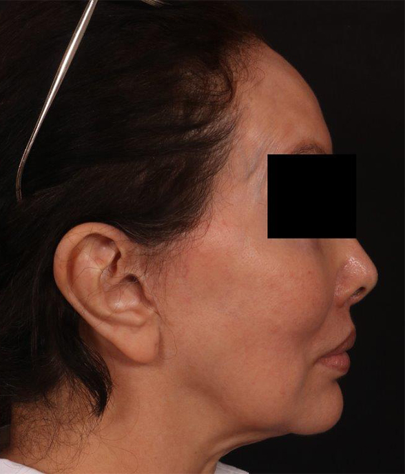 After Image: Lip Lift - right-side