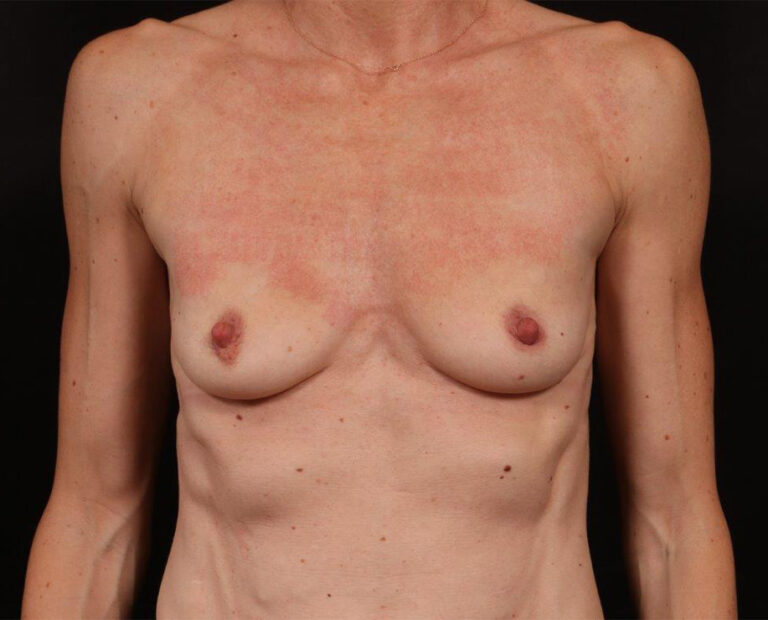 Before Image: Breast Augmentation - front