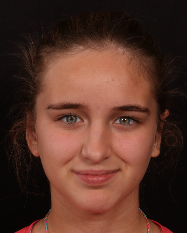 After Image: Otoplasty - front