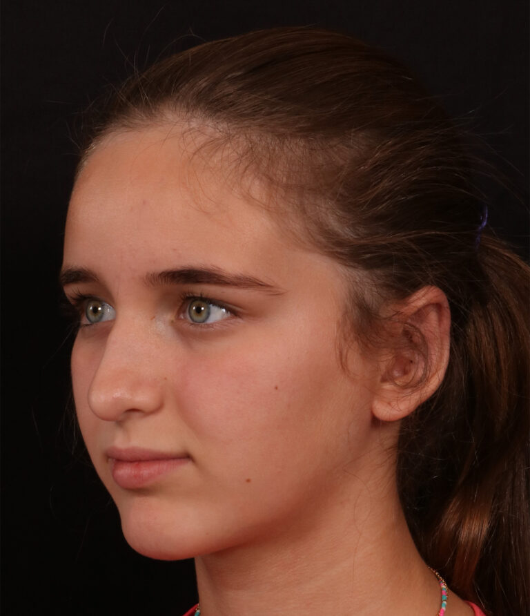 After Image: Otoplasty - left-front-oblique