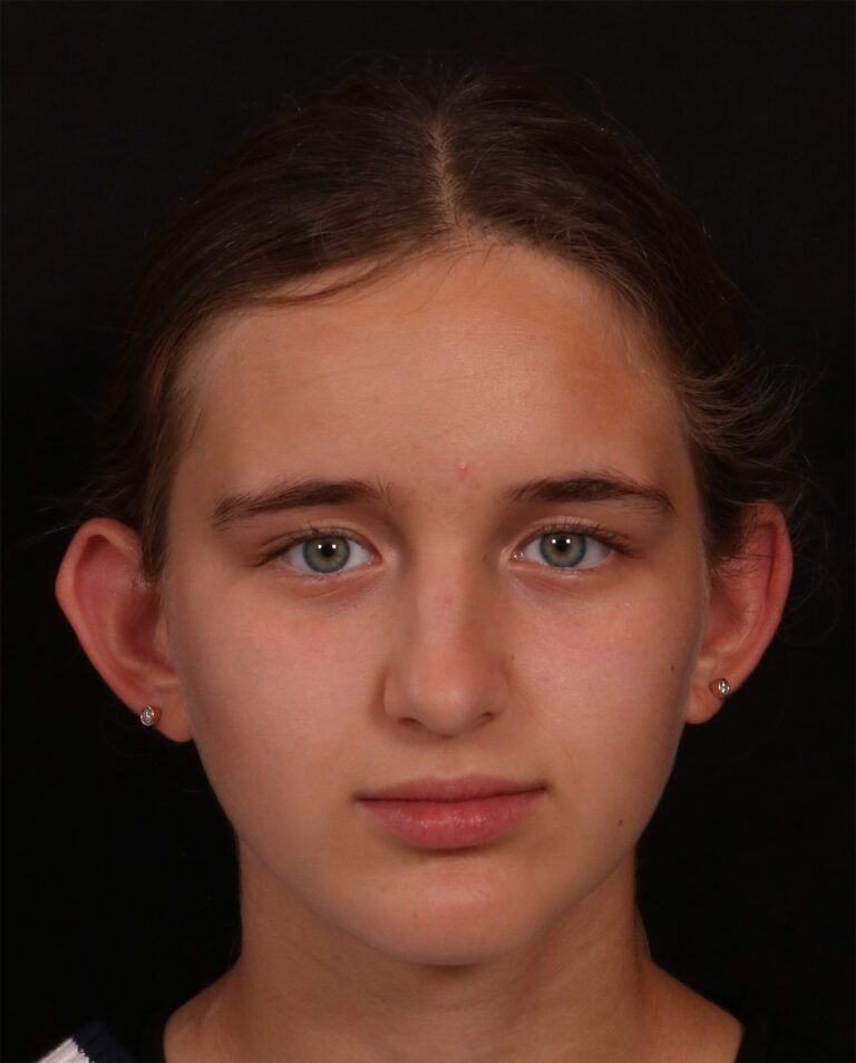 Before Image: Otoplasty - front