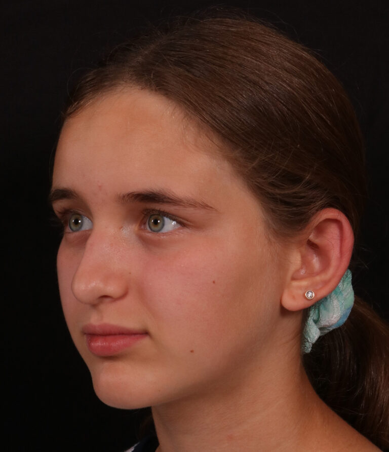 Before Image: Otoplasty - left-front-oblique