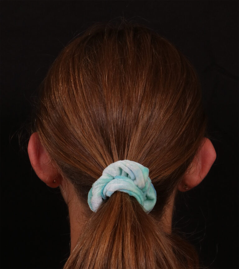 Before Image: Otoplasty - back