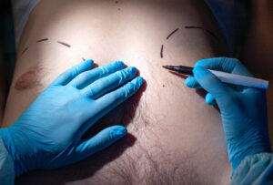 Doctor plastic surgeon makes marks with a felt tip pen for plastic surgery to correct male breast, close up. Gynecomastia