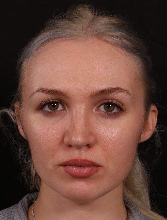 After Image: Rhinoplasty - front