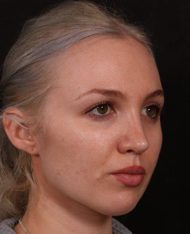 After Image: Rhinoplasty - right-front-oblique