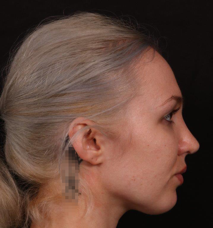 After Image: Rhinoplasty - right-side