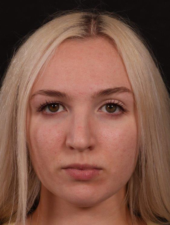 Before Image: Rhinoplasty - front