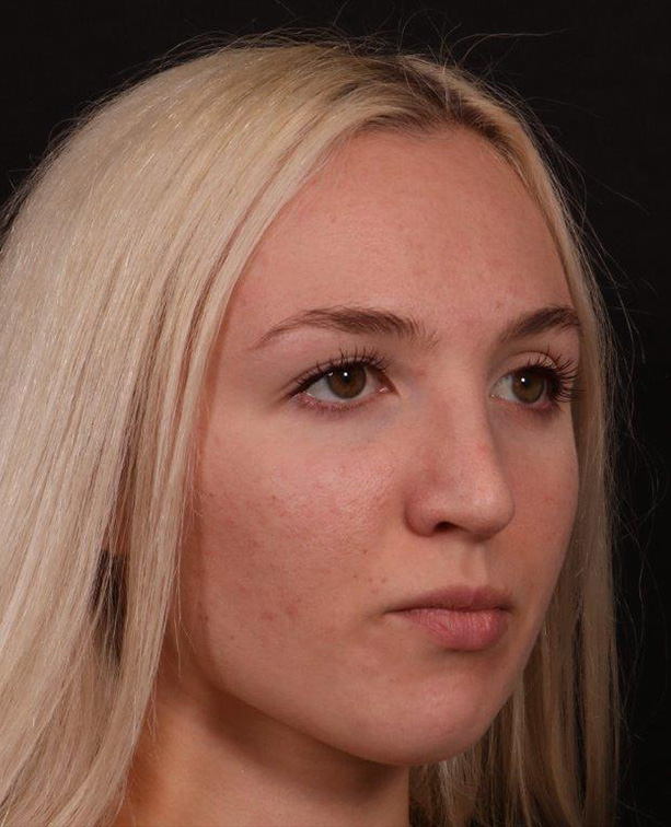 Before Image: Rhinoplasty - right-front-oblique