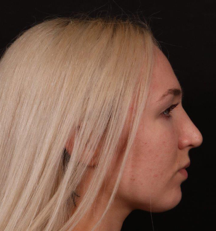 Before Image: Rhinoplasty - right-side